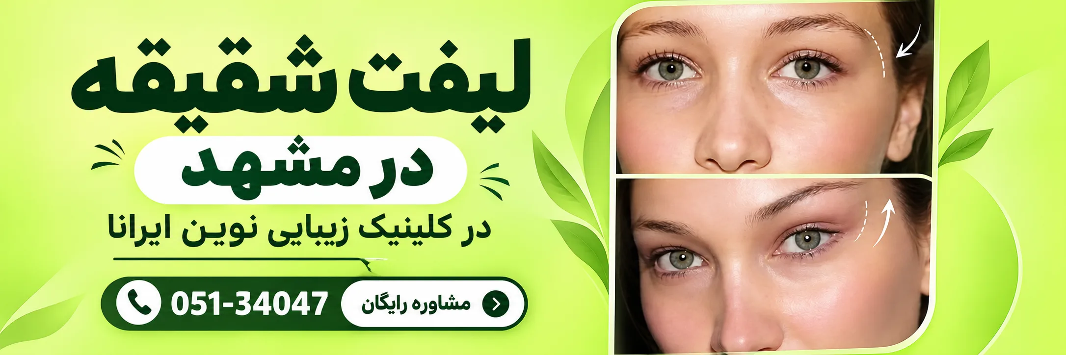 لیفت شقیقه در کلینیک زیبایی نوین ایرانا
